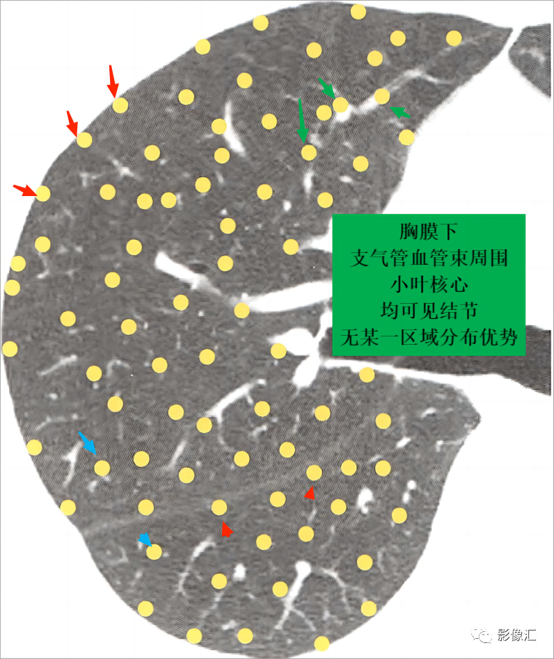 肺结节的三种分布模式