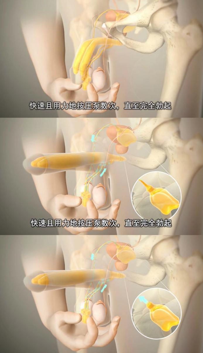 丁丁短小,勃起无力,该如何获得性福?