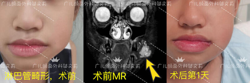 淋巴管畸形-1.jpg