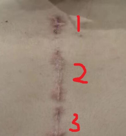 3 手术后伤口-1.jpg