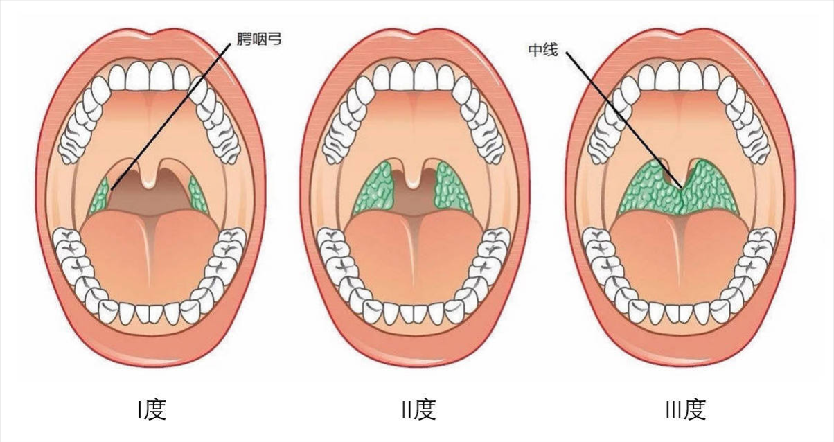 扁桃体分度.jpg