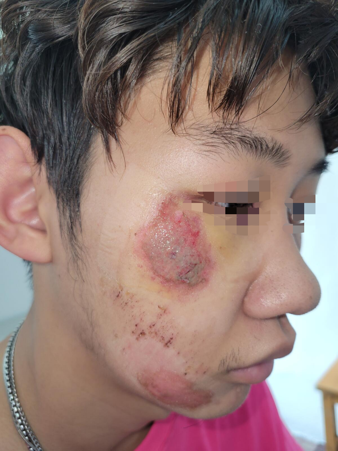 中西医混合治疗面部擦挫伤