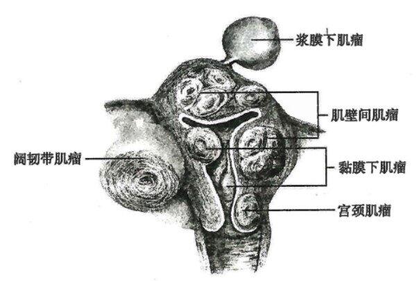 子宫肌瘤.jpg