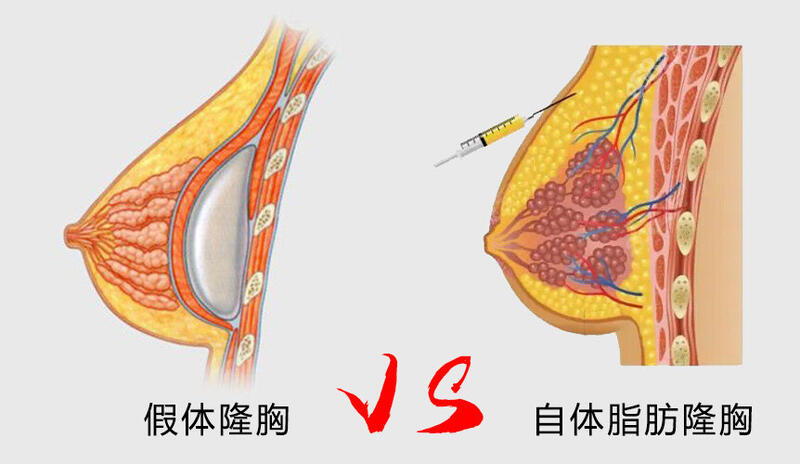 假体自体.jpg