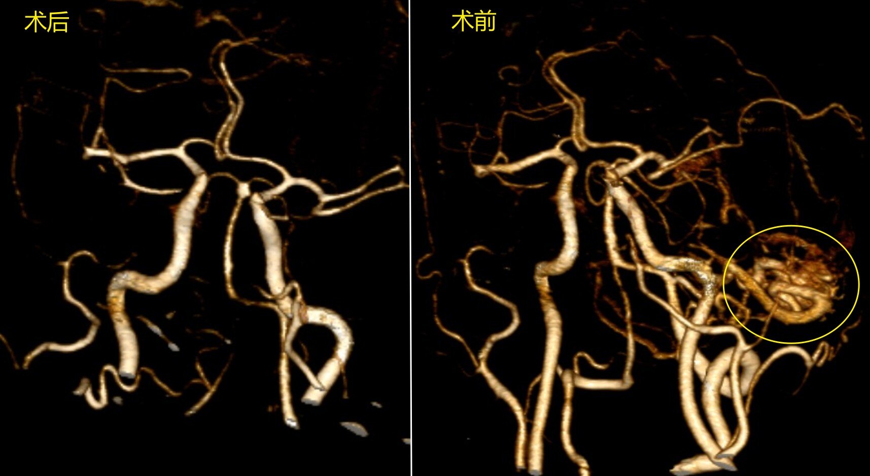 小脑蚓部血管畸形图片