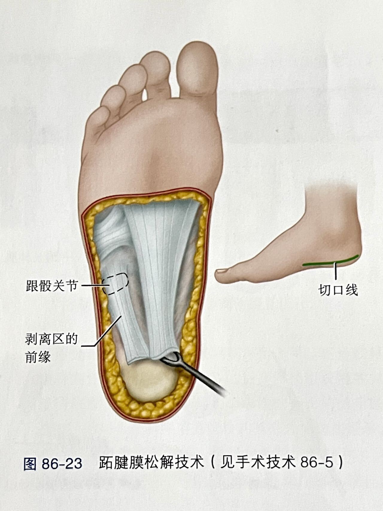 马蹄内翻足手术图片