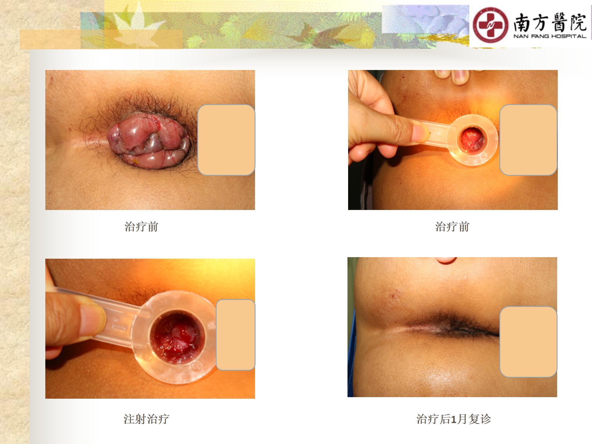 痔的精准化规范化微创化治疗之痔脱出3_15.jpg