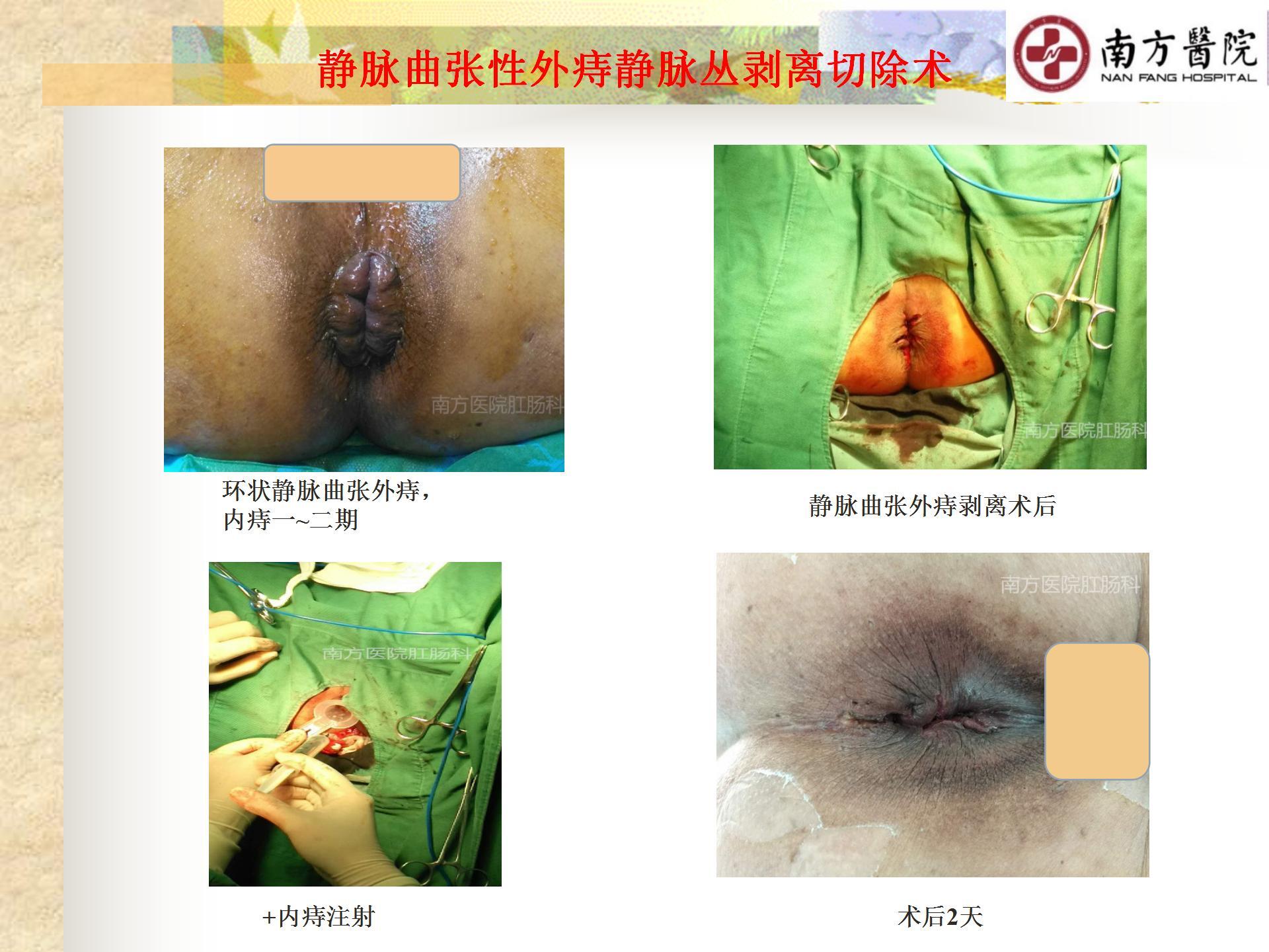 痔的精准化规范化微创化治疗之痔脱出3_32.jpg