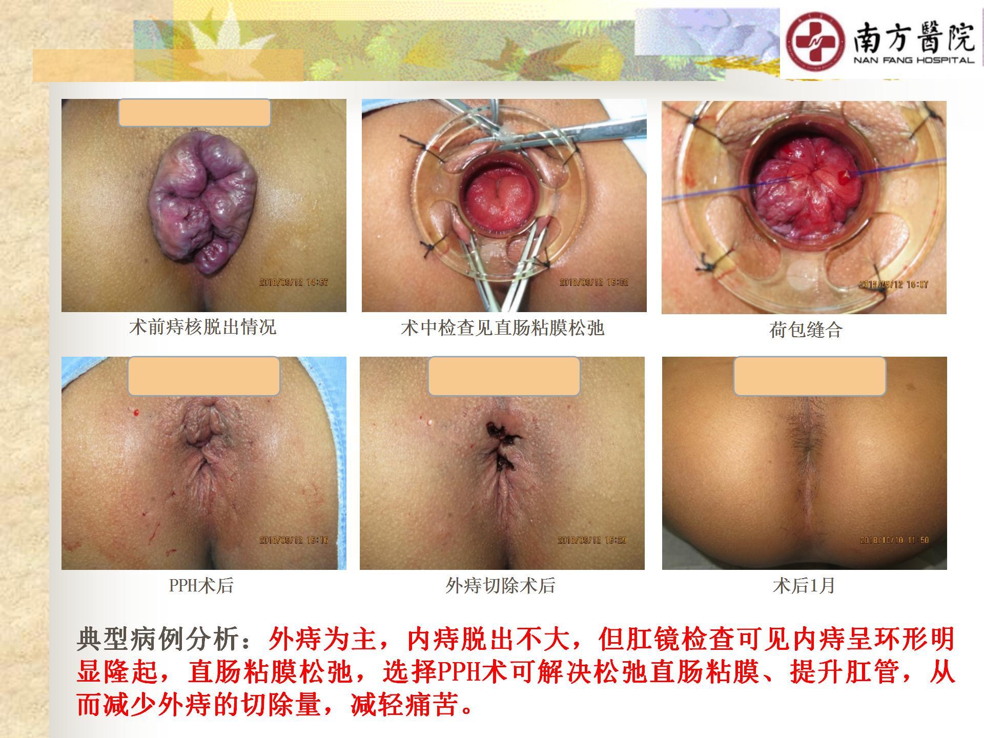 痔的精准化规范化微创化治疗之痔脱出3_22.jpg