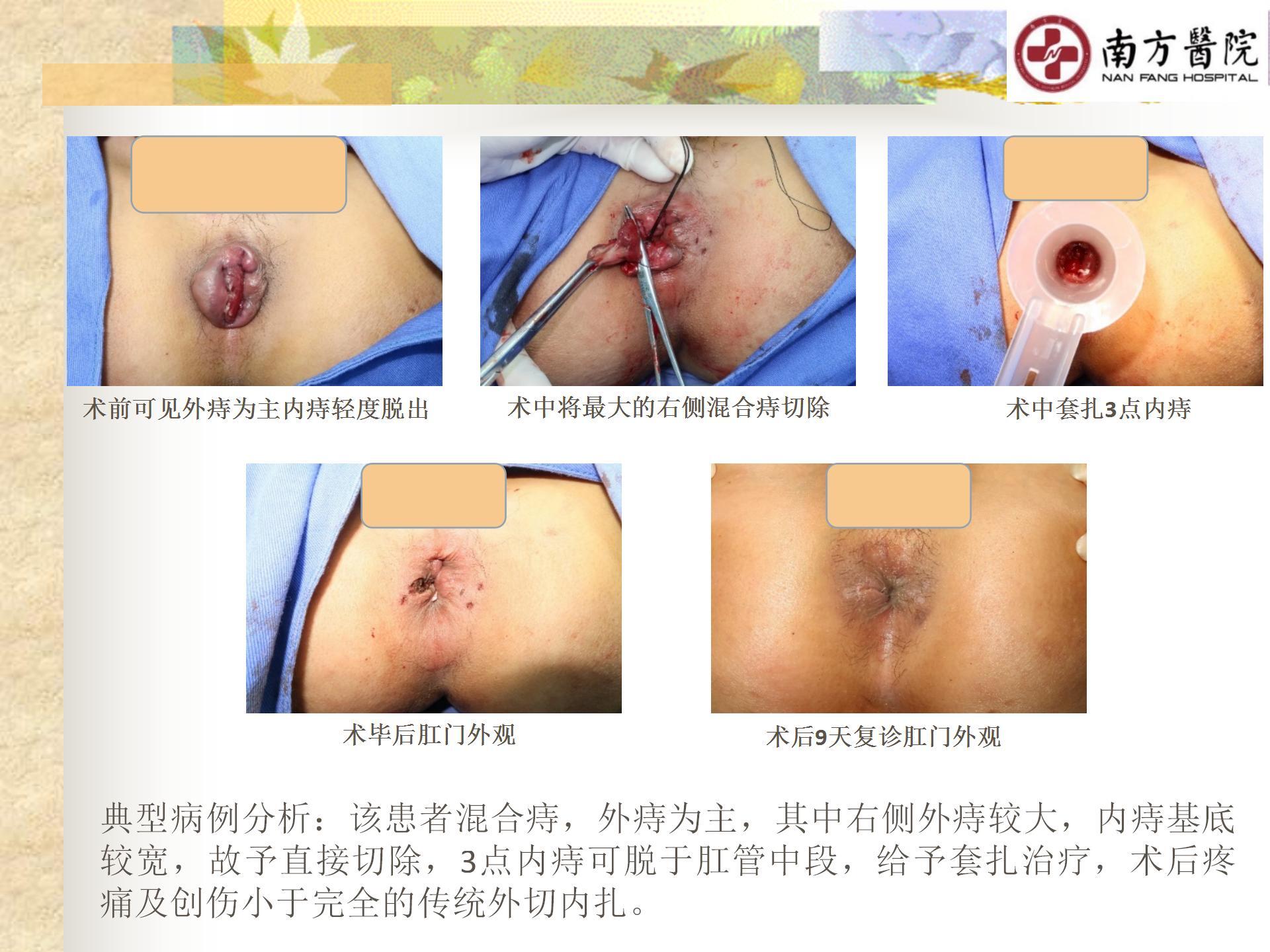 痔的精准化规范化微创化治疗之痔脱出3_13.jpg