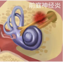 眩晕科普第三期:前庭神经炎 - 好大夫在线
