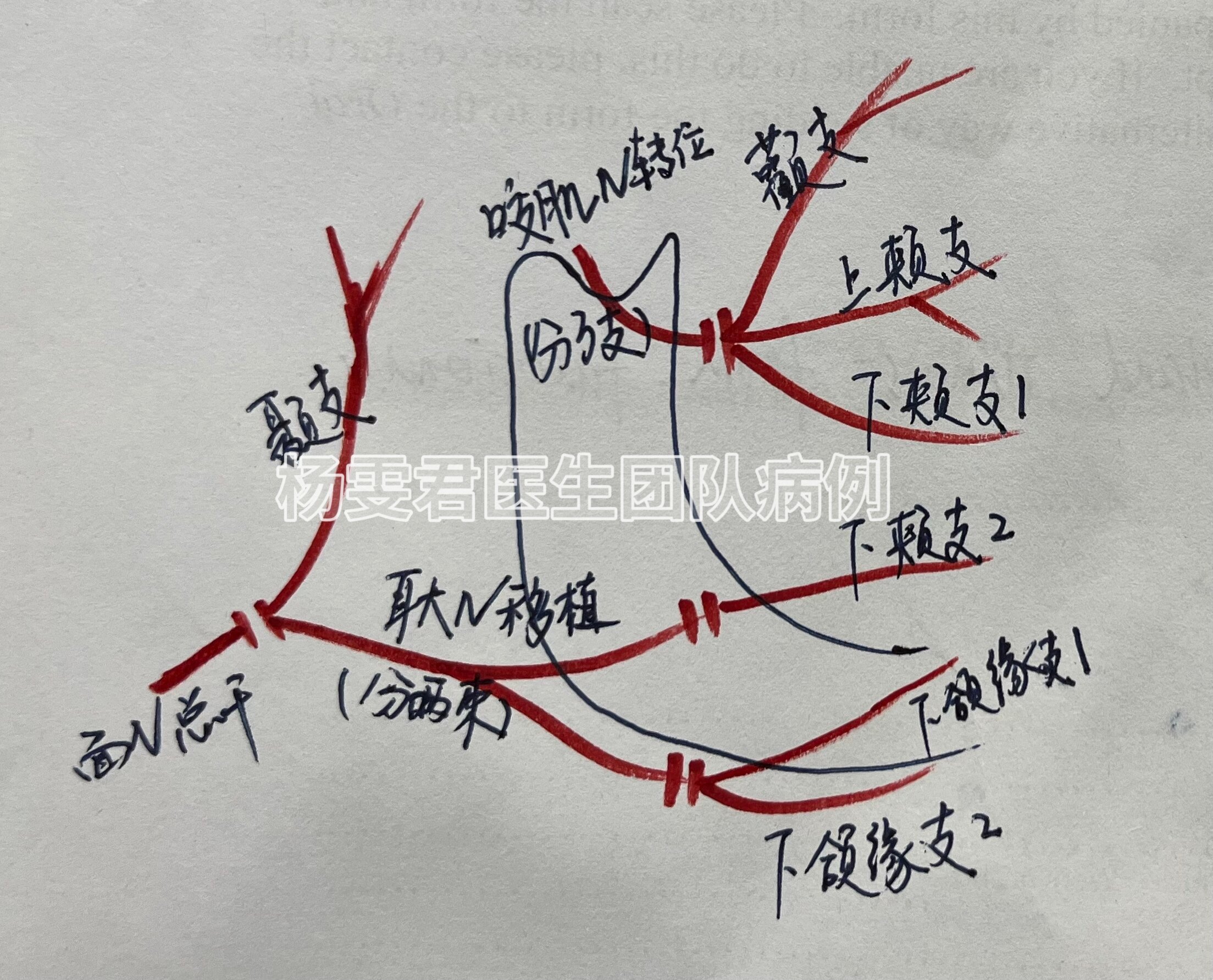 广泛复发腮腺混合瘤同期切除+面神经重建 - 好大夫在线
