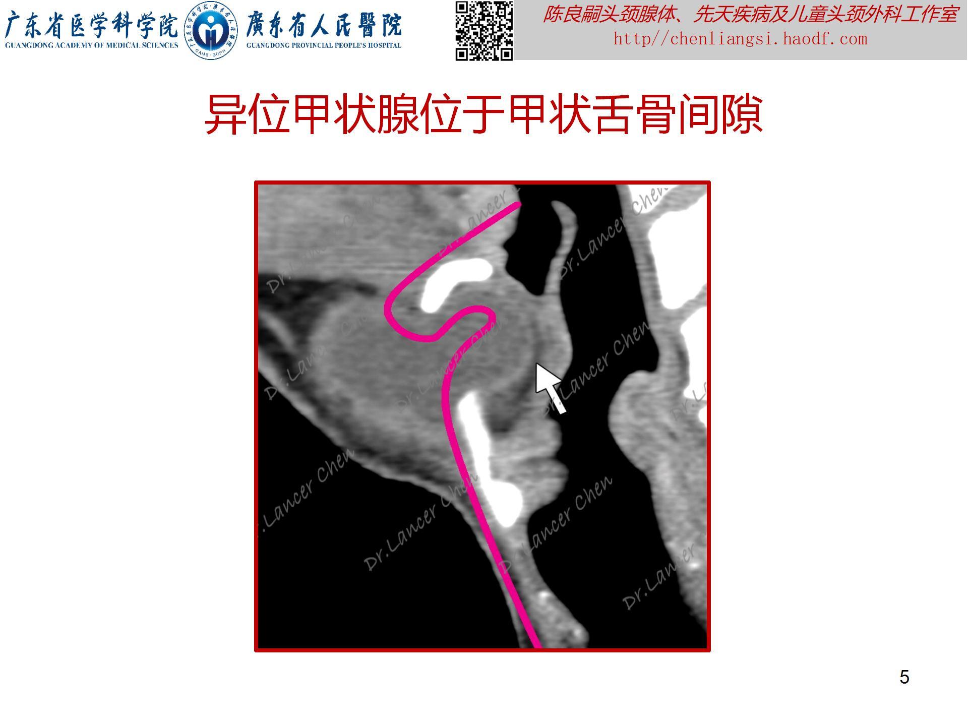 20230723：医学科普——貌似甲状舌管囊肿的罕见先天疾患——异位甲状腺_05.jpg