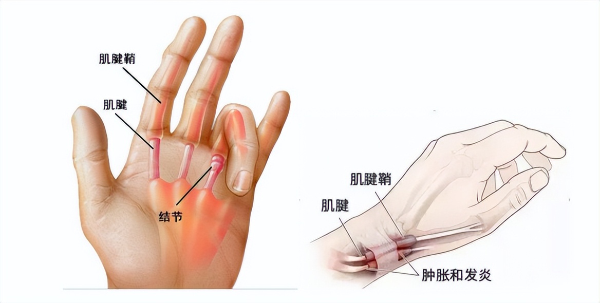 拇指屈指肌腱腱鞘炎图片