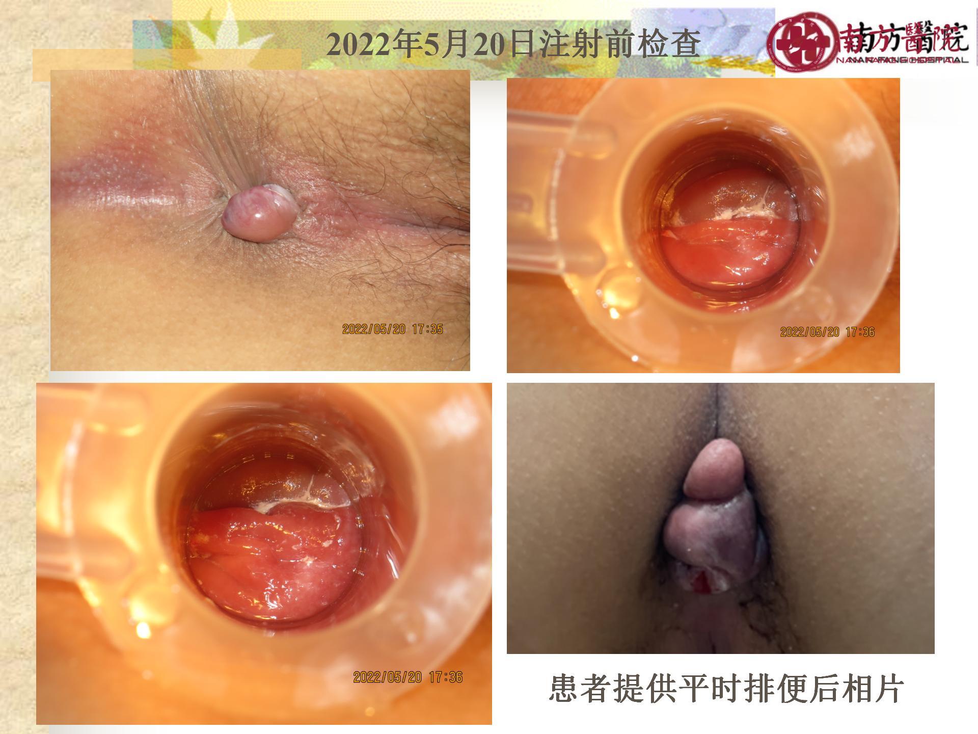 痔的精准化规范化微创化治疗之痔出血的治疗_20.jpg