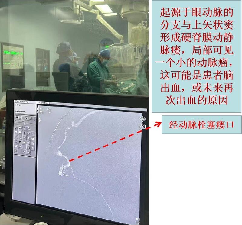 动脉栓塞.jpg