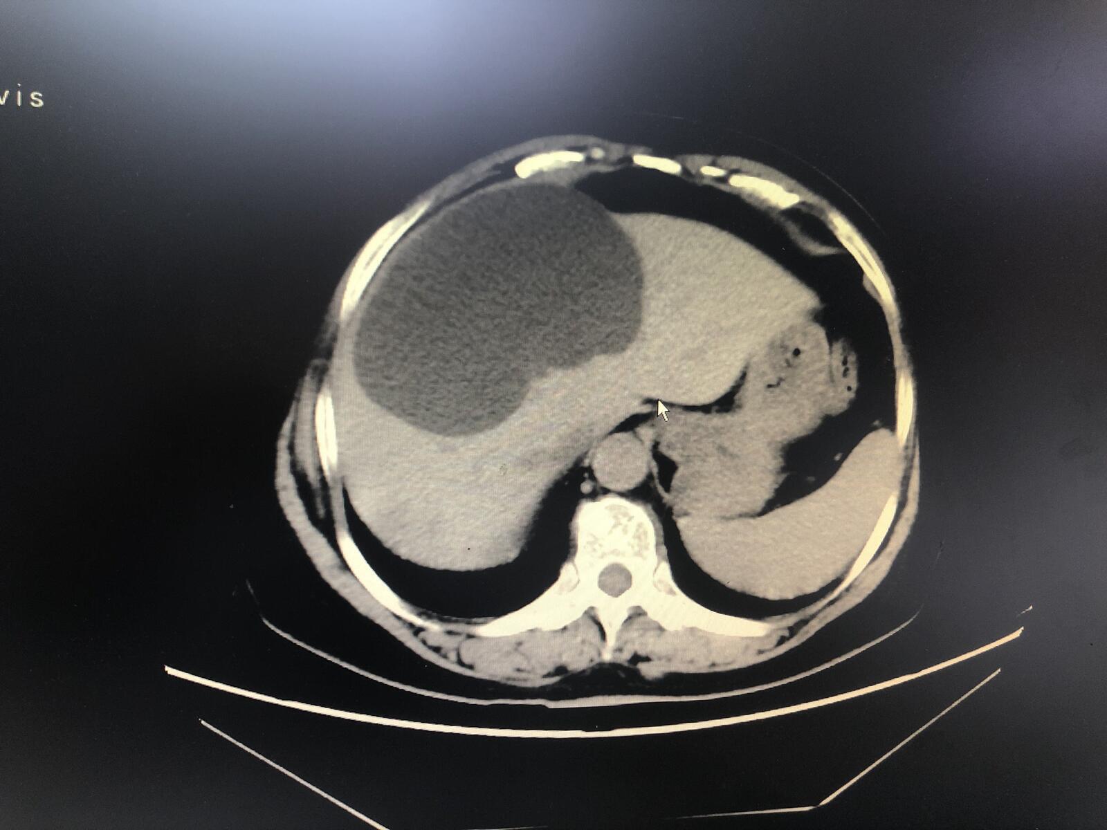 195,美国胃肠病学会对单纯性肝囊肿的推荐