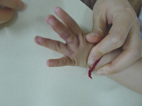 双翼皮瓣成形指蹼-——并指不植皮或减少植皮的新方法 - 好大夫在线