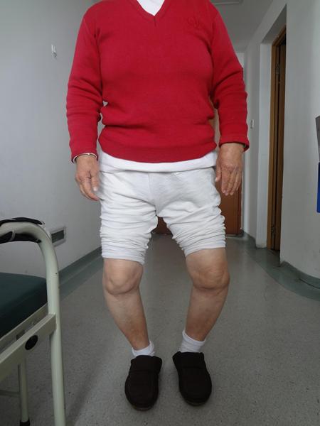 罗圈腿--严重膝内翻畸形伴有骨缺损的挑战性膝关节置换手术治.