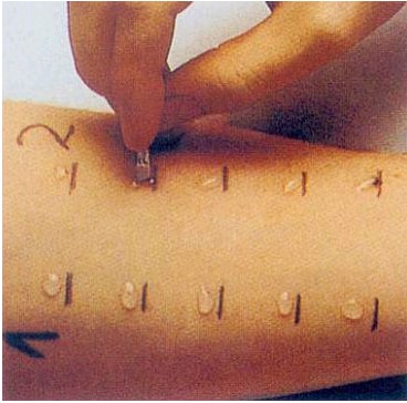 过敏原检测:皮肤点刺试验(图示)