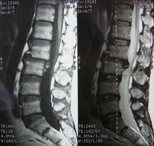 椎间盘突出症状, 夜间痛比较明显,可有脊髓半切症,查体:lasegue可为