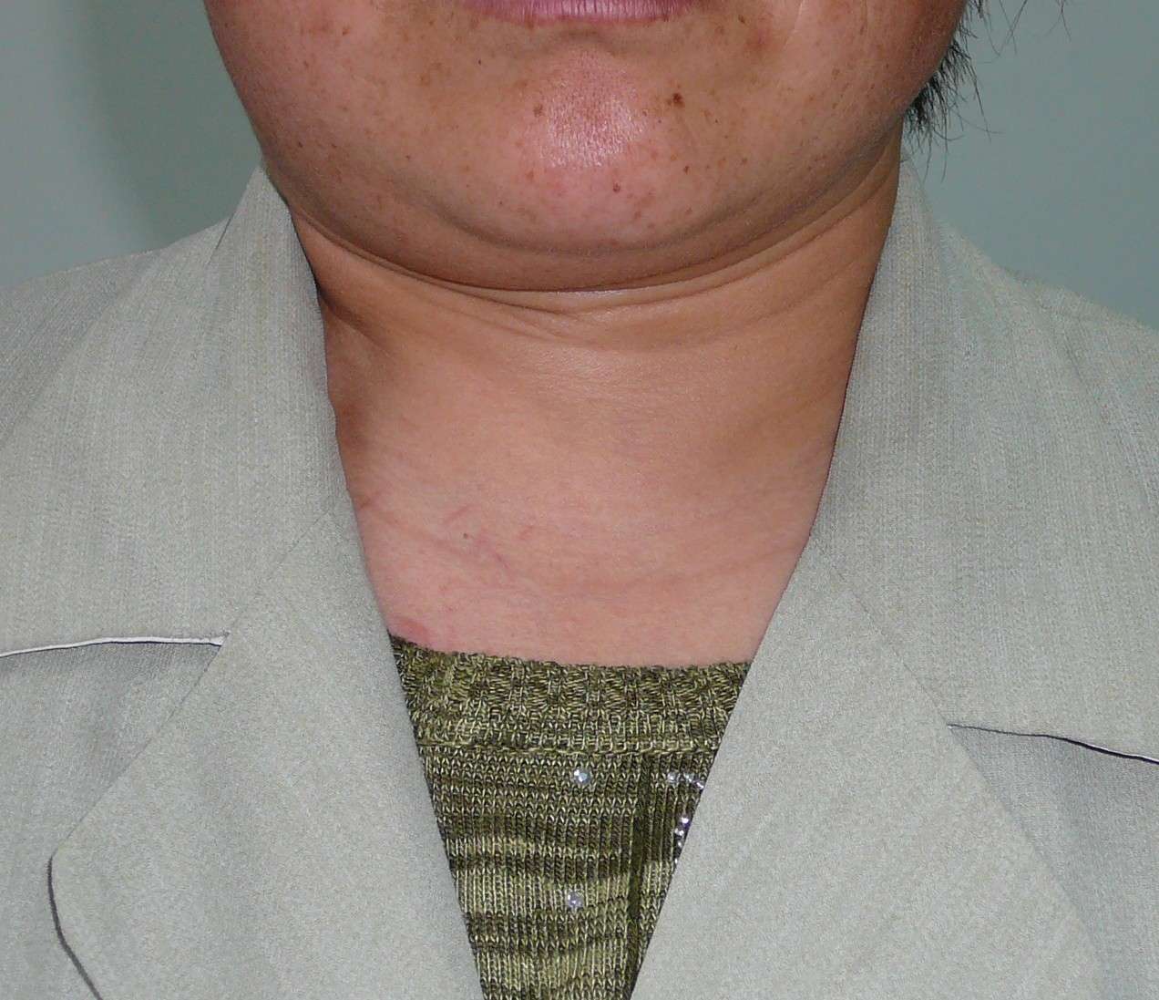 图3-58 颈深部及腋窝淋巴结模式图-基础医学-医学