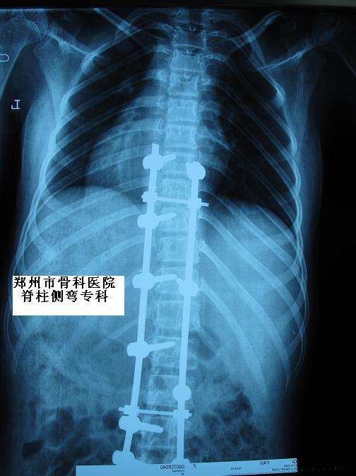 脊柱侧弯专科典型病例六