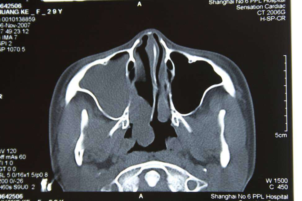 鼻内镜下切除上颌窦后鼻孔息肉