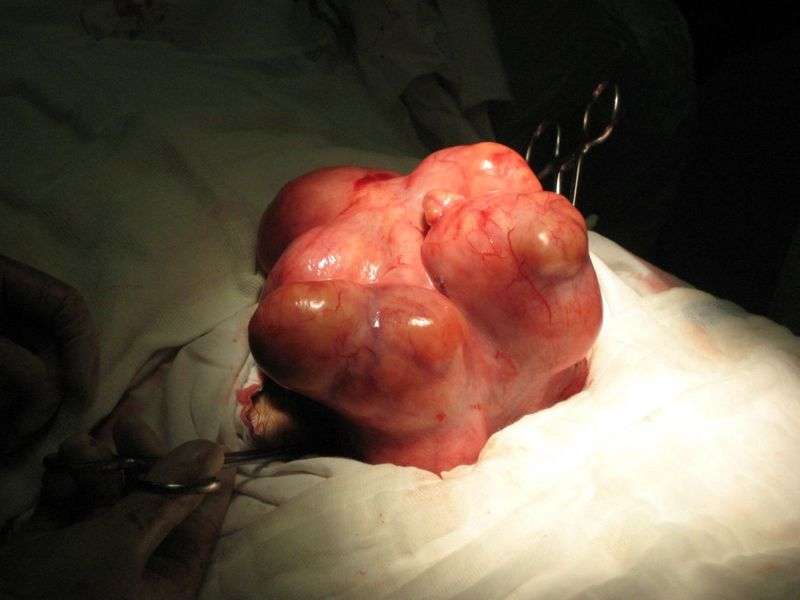 恶性子宫肌瘤图片图片