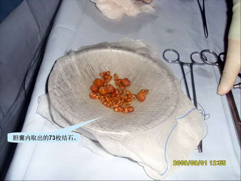 胆囊息肉病人写的看病经历!