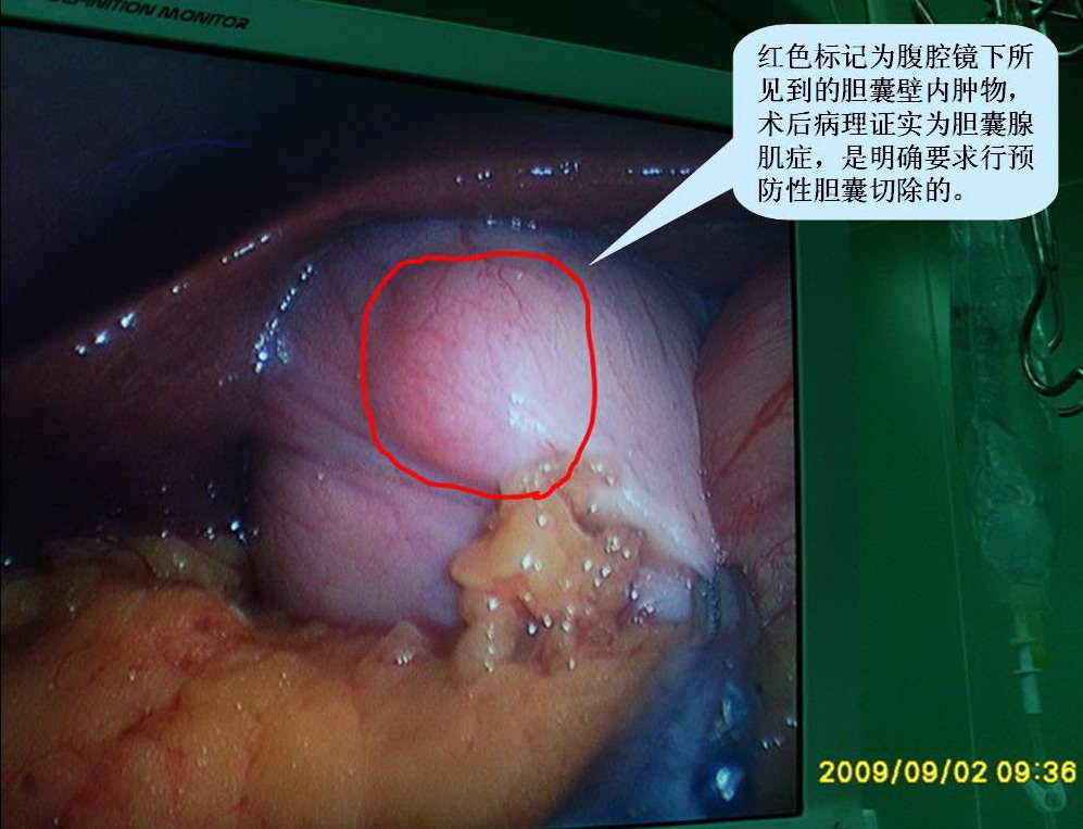 胆囊息肉病人写的看病经历