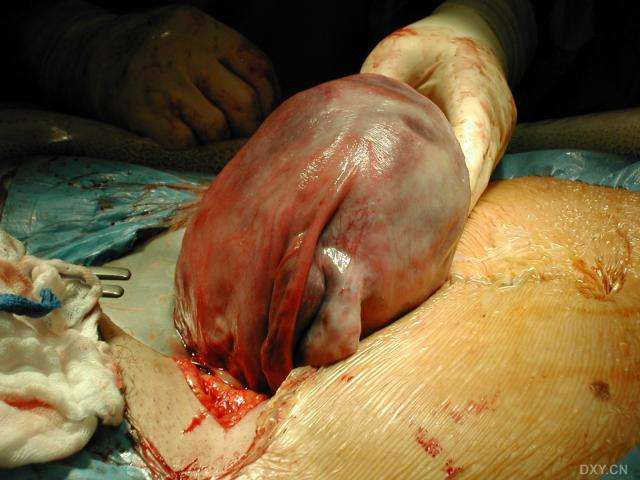 剖宫产真实图片2 