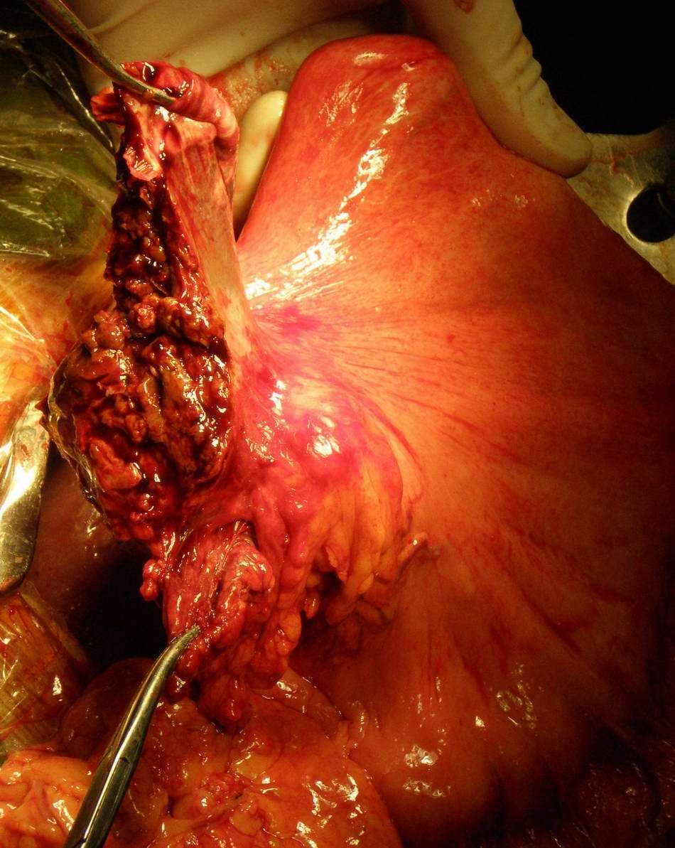 外生性肝癌肝外直接浸润胃----并"借用"胃的淋巴途径腹腔多发淋巴结