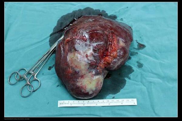 肝血管瘤多大需要手术