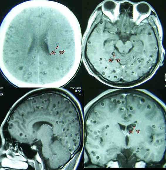 脑寄生虫病图片图片