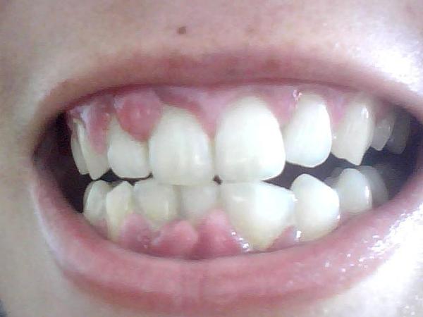 牙石等,可使一些孕妇出现牙龈增生有的甚至会在牙床上长出一个称之