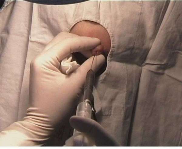 5.乳管镜辅助病变乳管微创切除手术4.