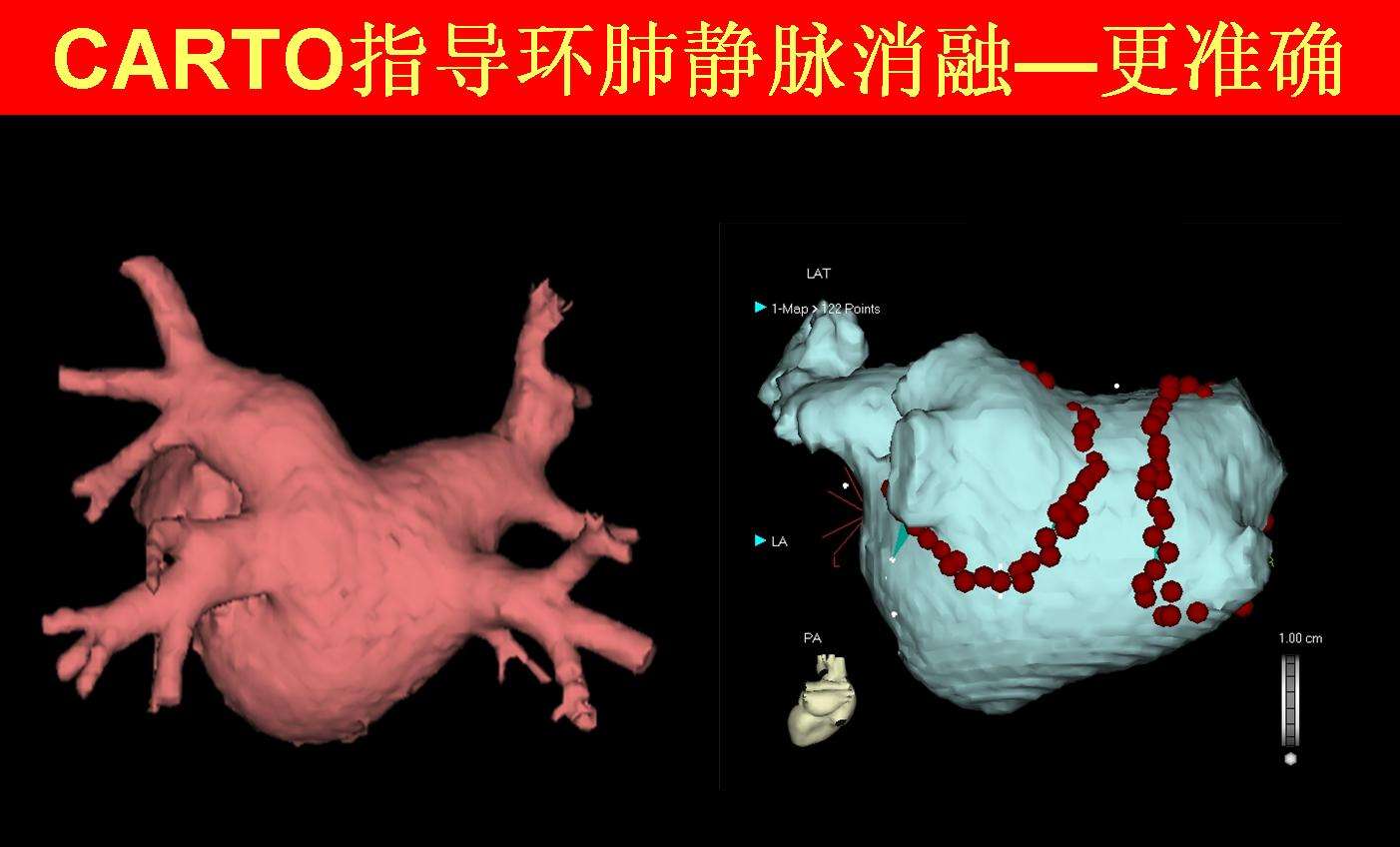 carto指导下消融房颤
