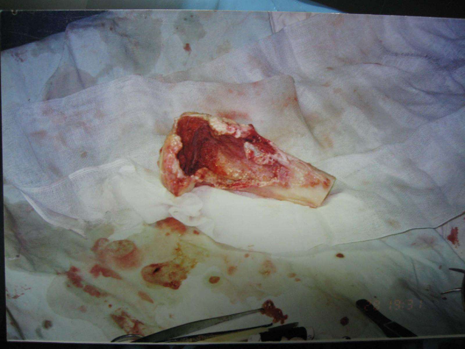 一例胫骨上端恶性骨肉瘤治愈十年临床报告 - 好大夫在线