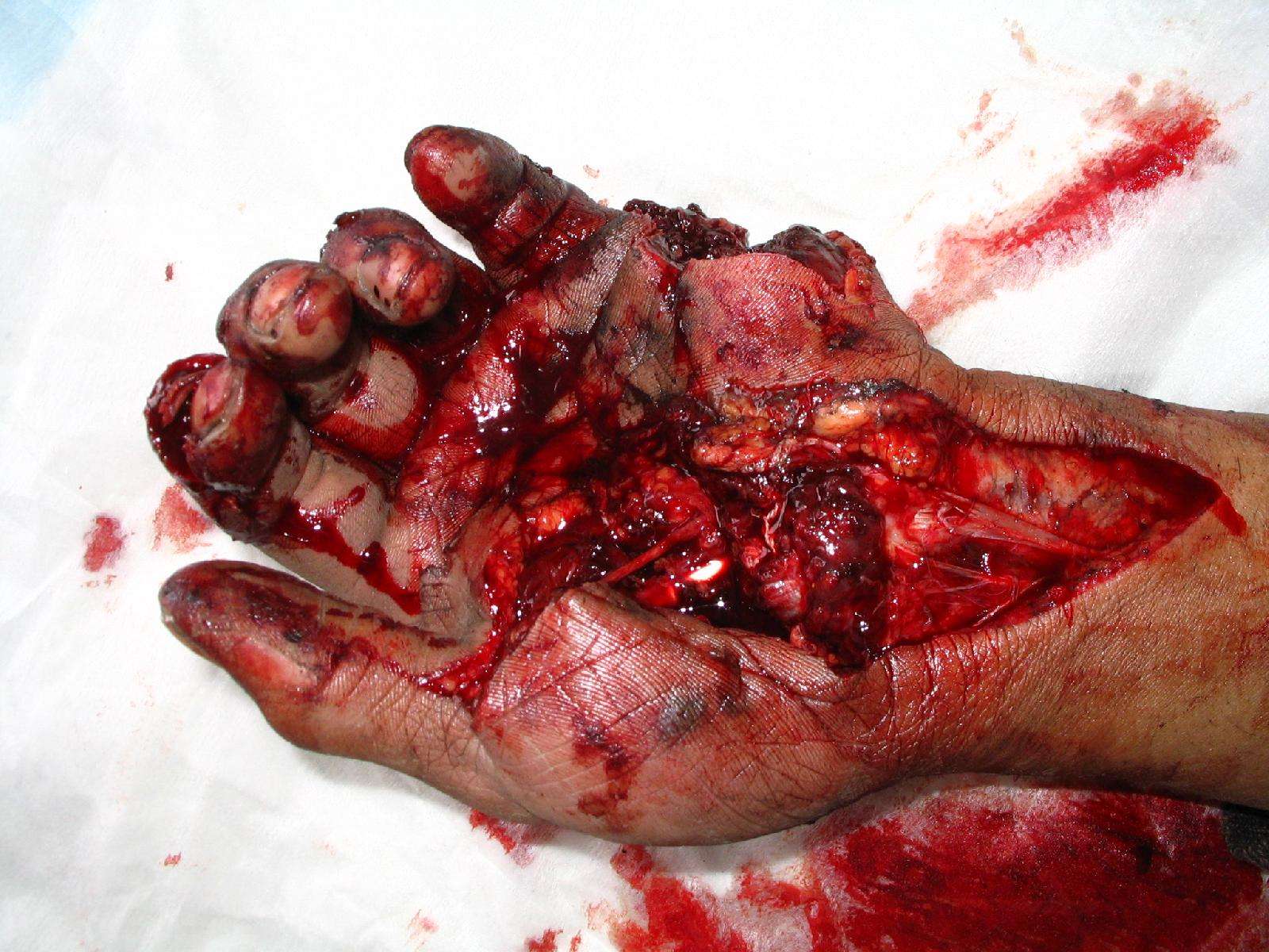 (图片)手部多发开放性损伤合并大多角骨脱位治疗