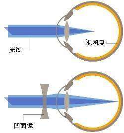 >做近视激光手术几个经典疑惑回答  答:近视眼分轴性近视和屈光性近视