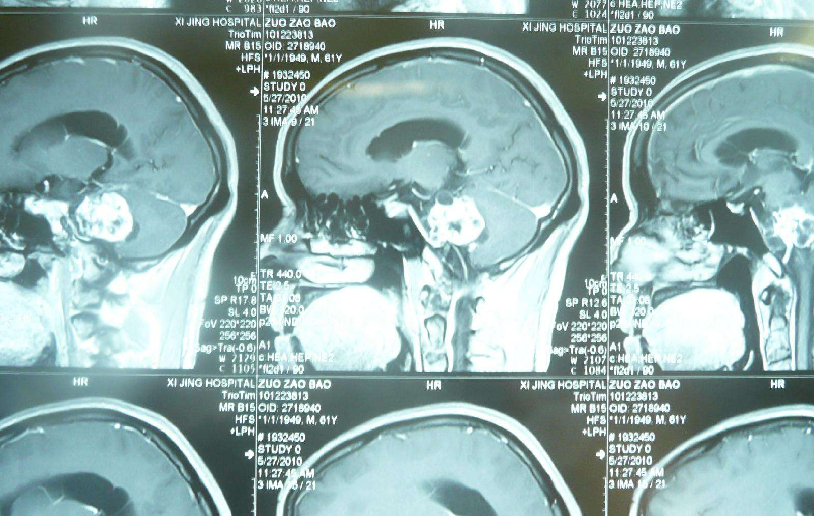 又来神经外科治疗,经ct检查,患者为神经外科疾病——听神经瘤