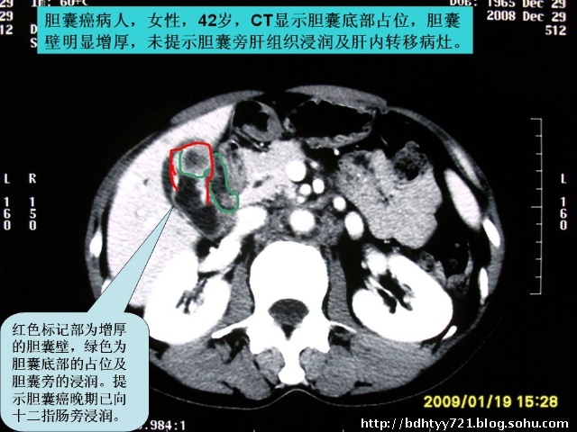 可怕的胆囊癌