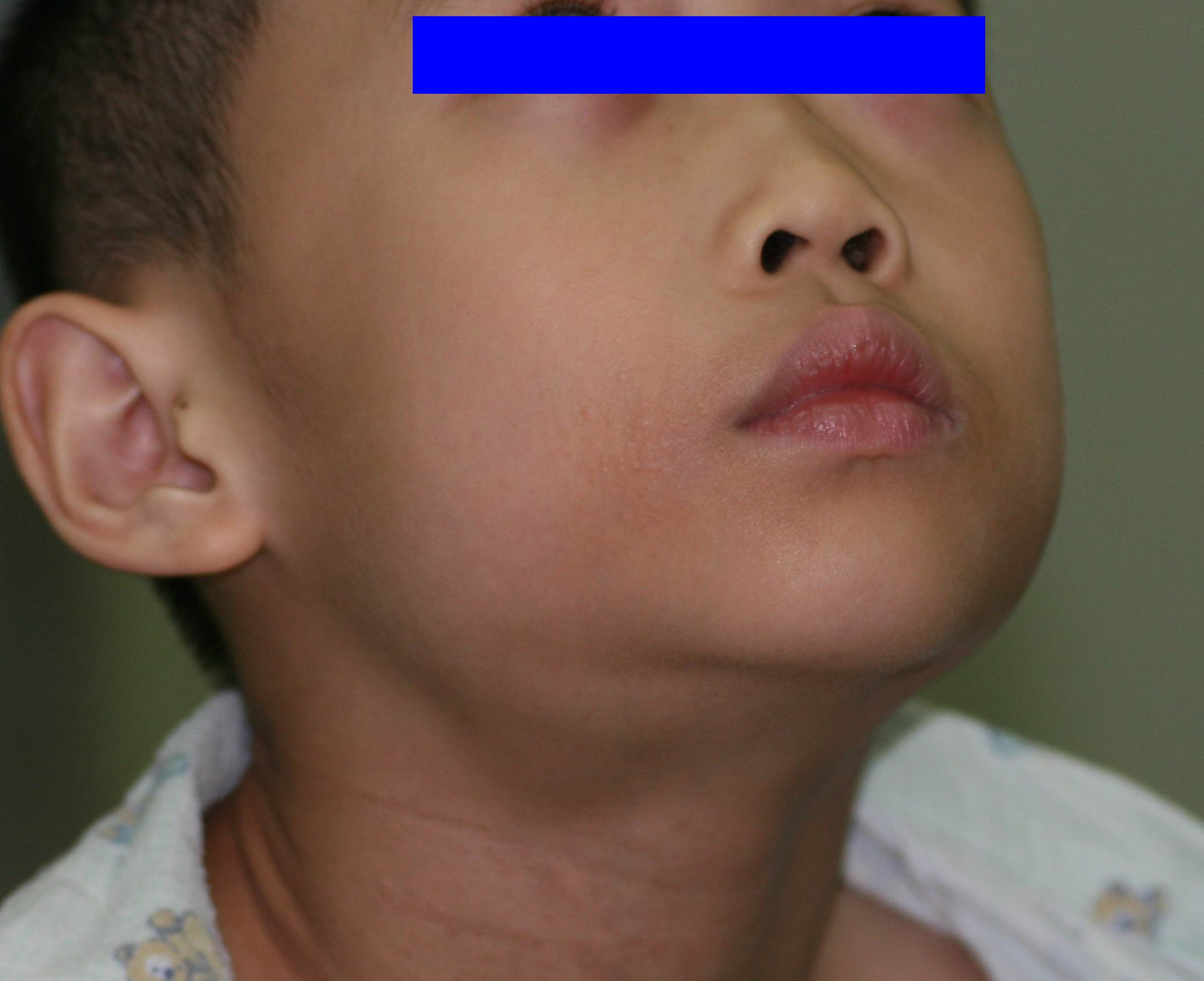 儿童口腔颌面部常见肿瘤