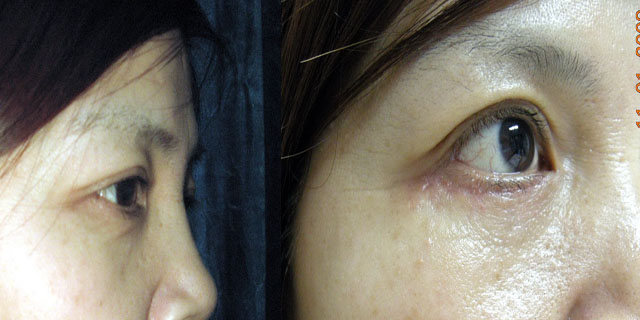 下眼袋脂肪下移修复同侧下眼袋伴下眶缘凹陷