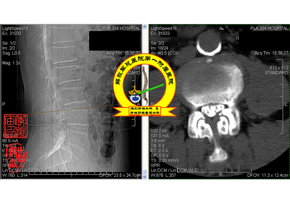 术前腰椎管造影后ct检查显示腰3-5椎管狭窄.