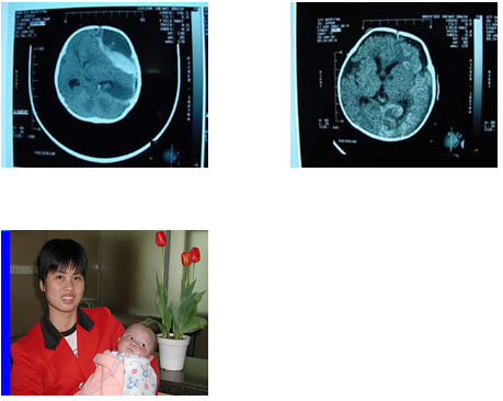 宝宝做脑部CT的副作用是什么？