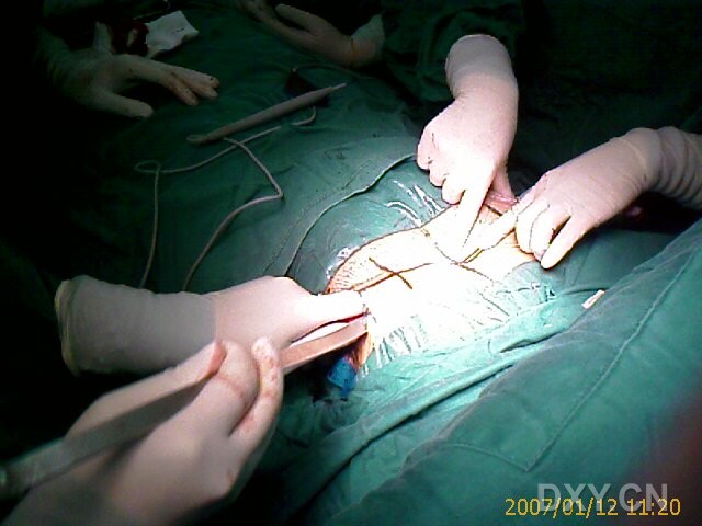 先天性漏斗胸微创手术矫治效果好