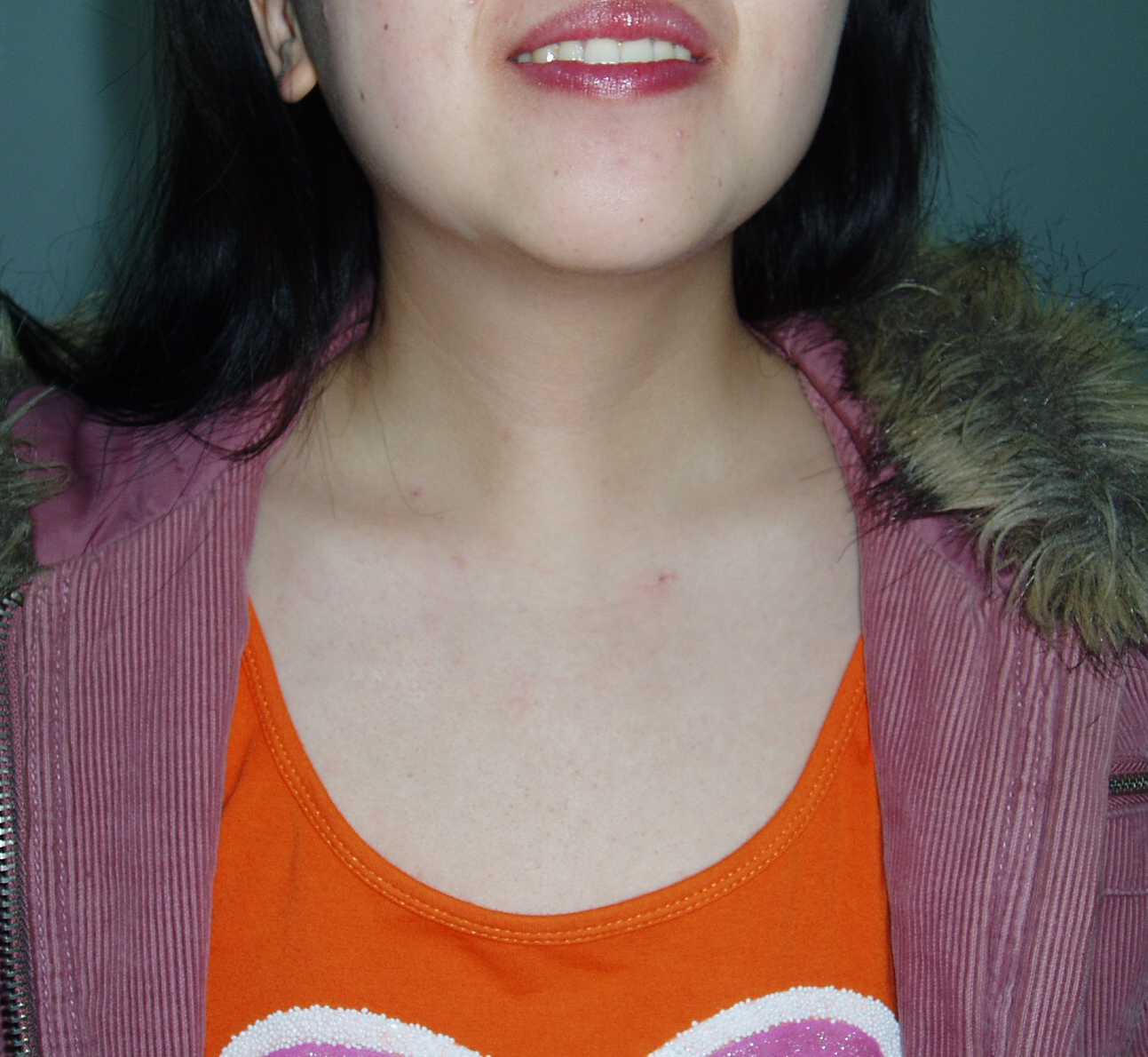 关于腔镜甲状腺手术_好大夫在线