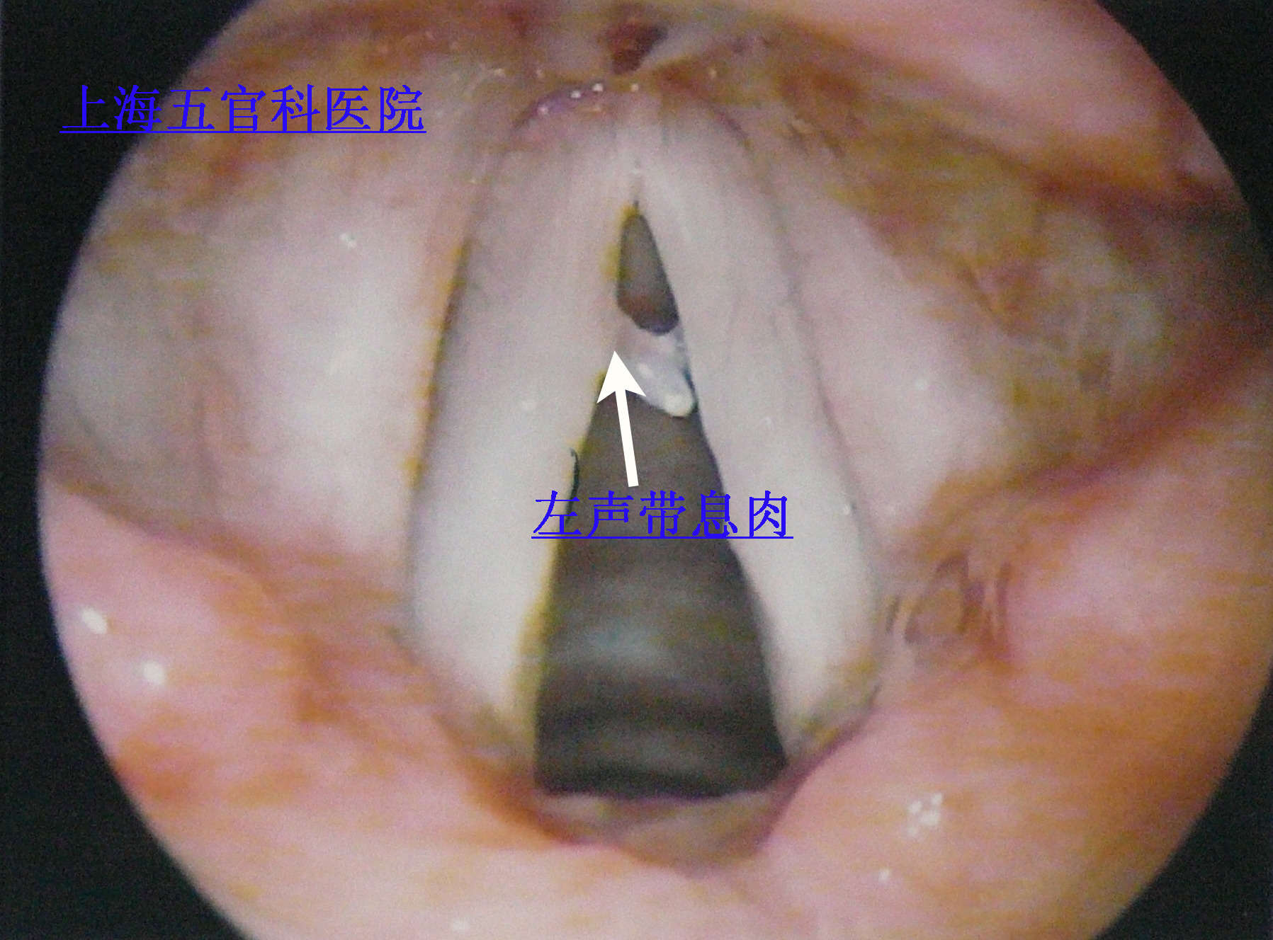 声带息肉图片喉镜图片
